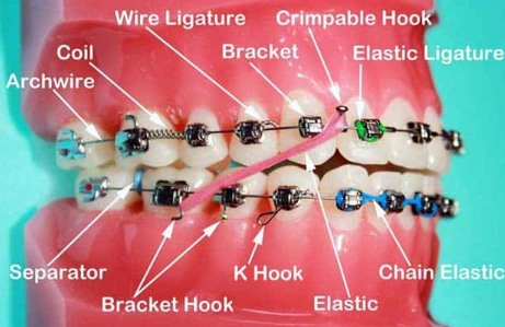 braces price in Kenya