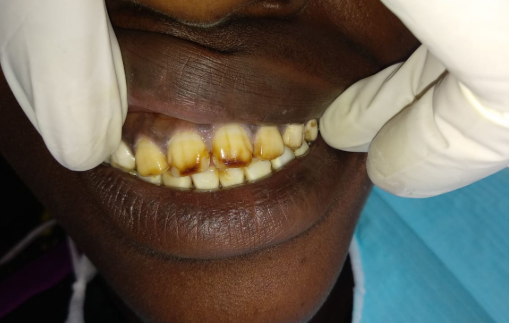 teeth whitening price in Kenya price table