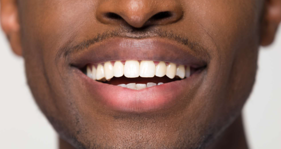 teeth whitening price in Kenya price table