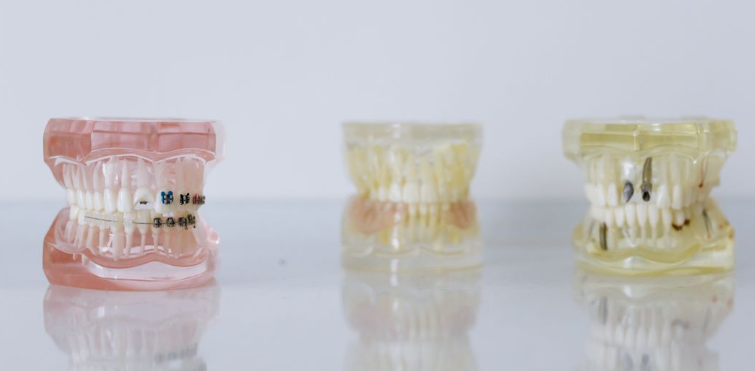 types of braces and cost in Kenya
