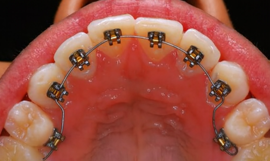 how long do braces take