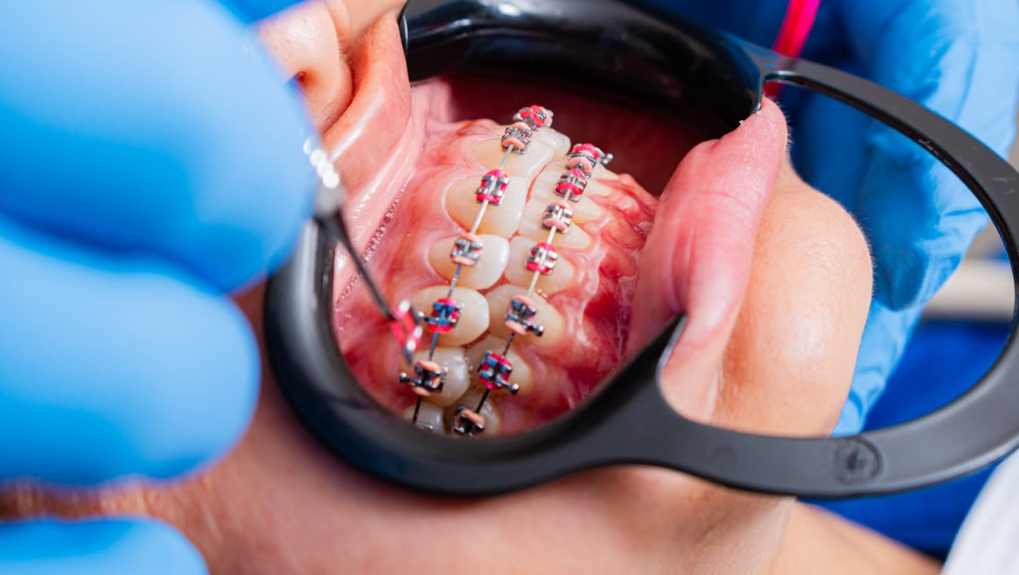 types of braces and cost in Kenya