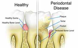 deep cleaning vs standard cleaning gum pocket diagram