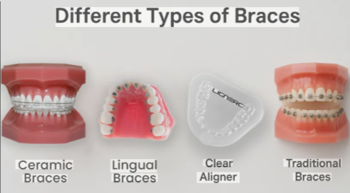 types of braces and cost in Kenya