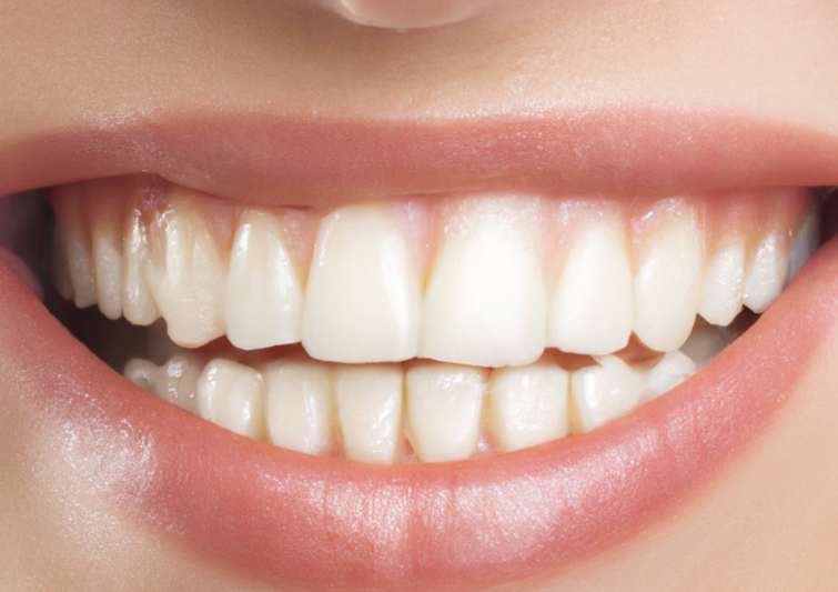 professional vs at-home whitening