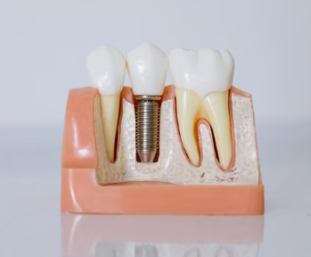 root canal vs extraction