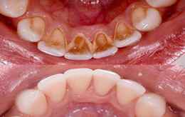 teeth cleaning price in Kenya before and after results