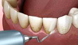 teeth cleaning price in Kenya scaling illustration