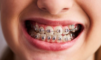 braces prices Githunguri