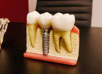 dental implants cost in Kenya cross section showing titanium post in jawbone