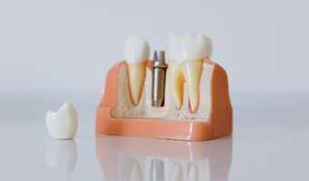 dental implants cost in Kenya model showing implant post abutment and crown