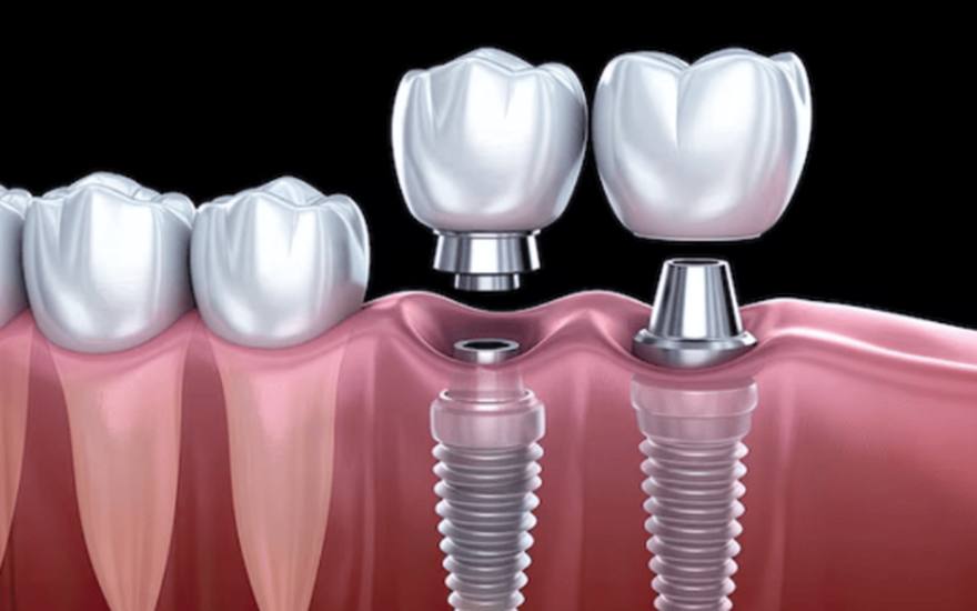 Illustration of a dental implant with crown replacing a missing tooth, Elephant Dental Clinic Kiambu