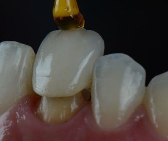 Dental crown being fitted onto a prepared tooth at Elephant Dental Kiambu Branch