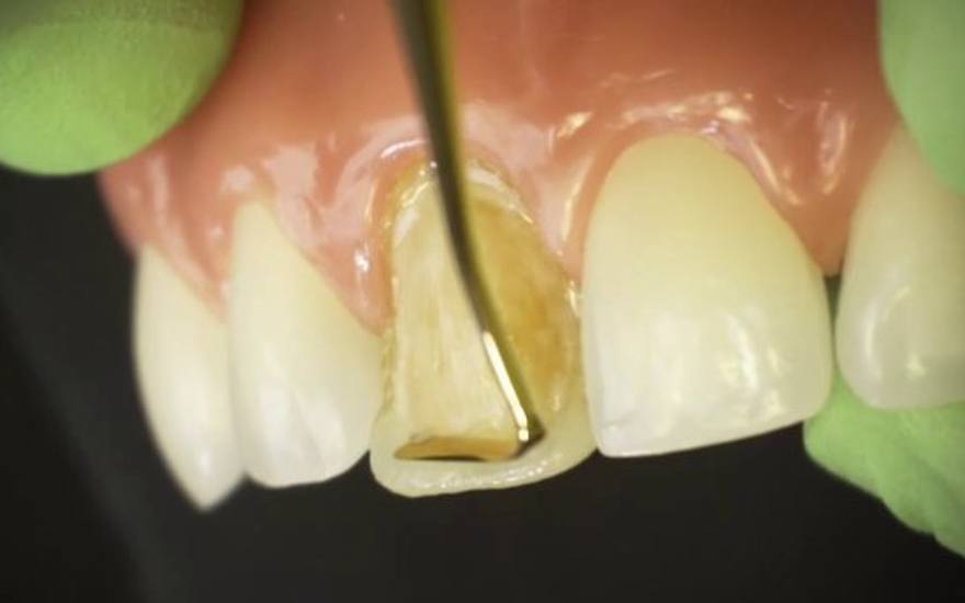 Natural looking dental veneer result at Elephant Dental Kiambu
