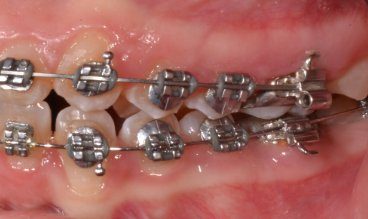 Close-up of dental braces applied to teeth at Elephant Dental Kiambu Branch
