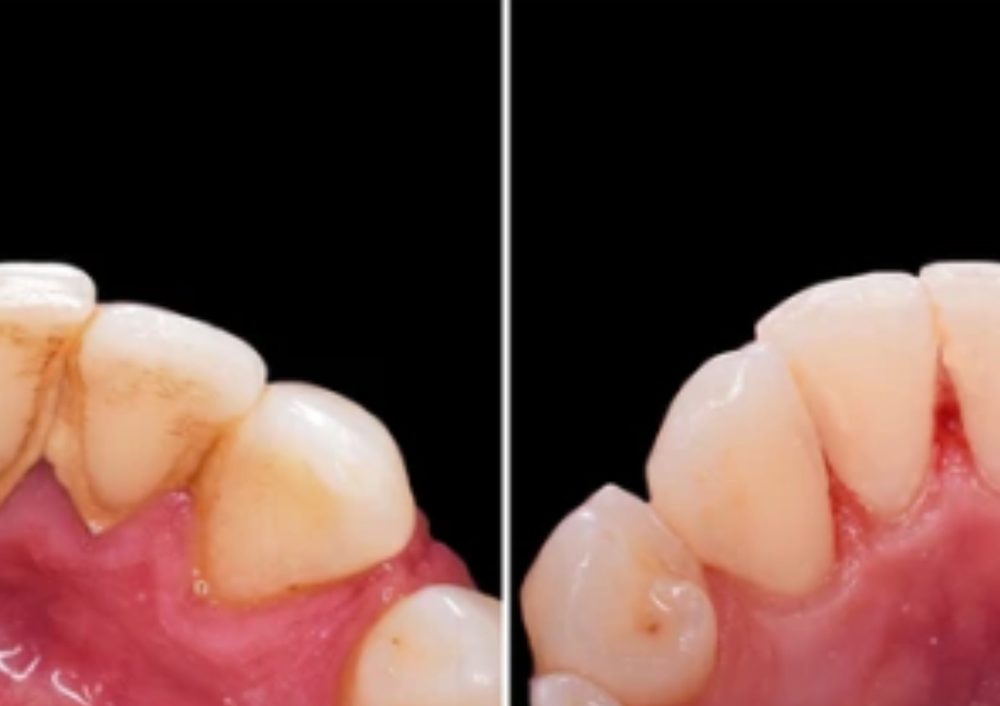 Same teeth after professional cleaning at Elephant Dental Kiambu, plaque removed