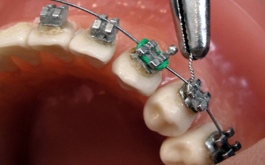 Orthodontic braces being adjusted, wire and bracket close up, at Elephant Dental Clinic Kiambu