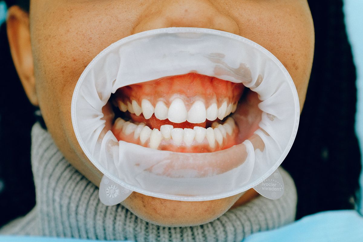 Professional teeth whitening procedure performed at Elephant Dental Kiambu Branch