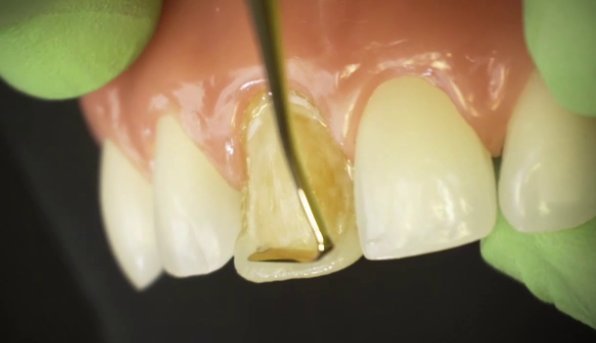 Teeth before professional cleaning, showing visible plaque and tartar build-up